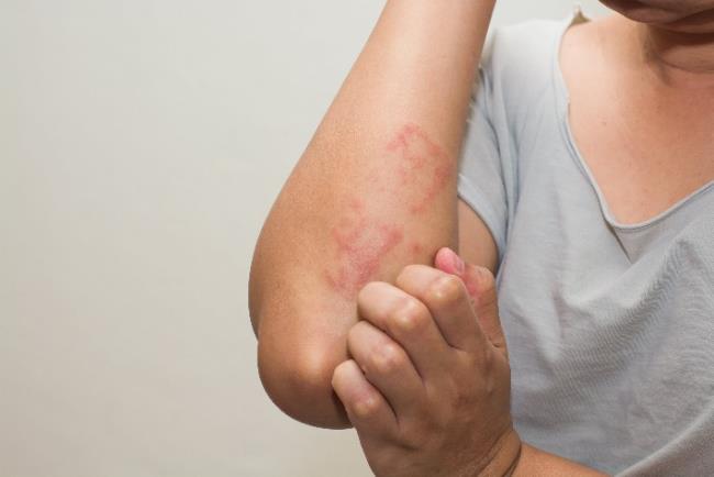 אישה מגרדת את היד, הידרוקורטיזון לטיפול במצבים דלקתיים ואלרגיים